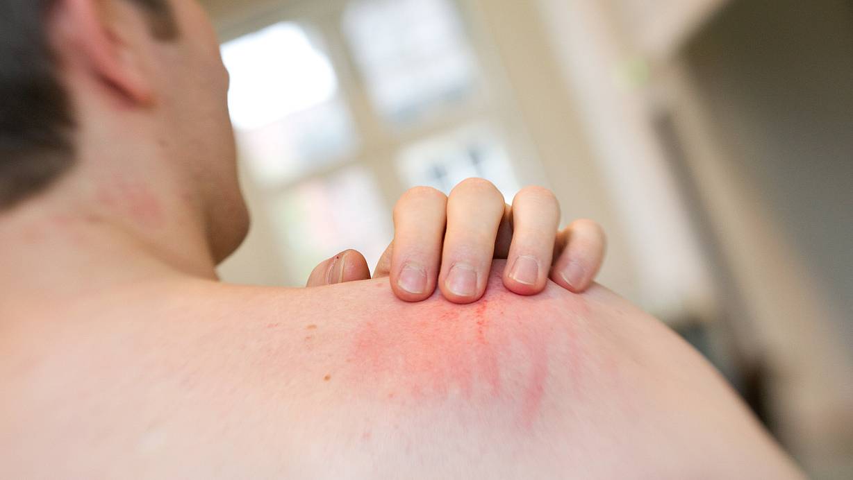 Die Zahl der Krätze-Fälle in Westfalen-Lippe steigt an. Das geht aus einer Auswertung der AOK Nordwest unter ihren Versicherten hervor. | © picture alliance / dpa