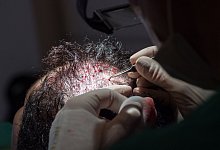 Haartransplantation nach der FUT-Methode bei einer Patientin - Andrea Warnecke/dpa-tmn