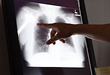 Röntgenbild in Schlichtungsstelle für Arzthaftpflichtfragen - Susann Prautsch/dpa/dpa-tmn