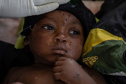 Ein an Mpox erkrankter zweijähriger Junge liegt in einem Krankenhaus in Kamituga im Osten des Kongo. - © Moses Sawasawa/AP
