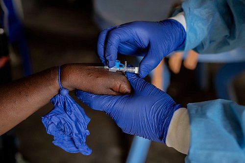 Ein erster Fall von Mpox ist in Deutschland nachgewiesen worden (Foto Archiv) - © Moses Sawasawa/AP/dpa